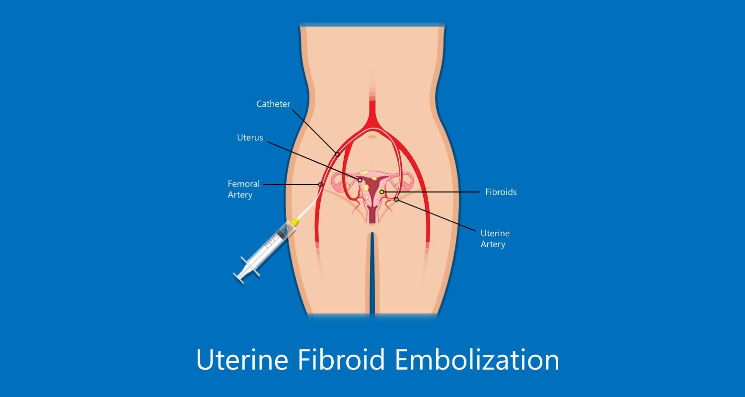 laparoscopic hysterectomy medical surgical treat