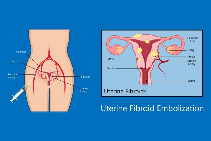 Fibroids And Sex What You Need To Know New York City 1 Fibroid Center 9465