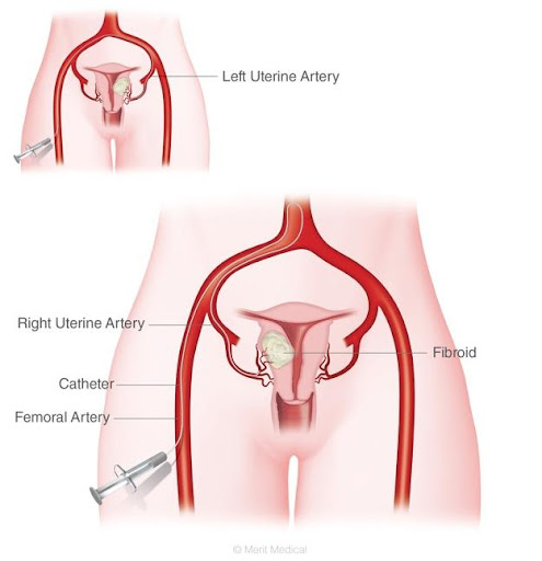 fibroids