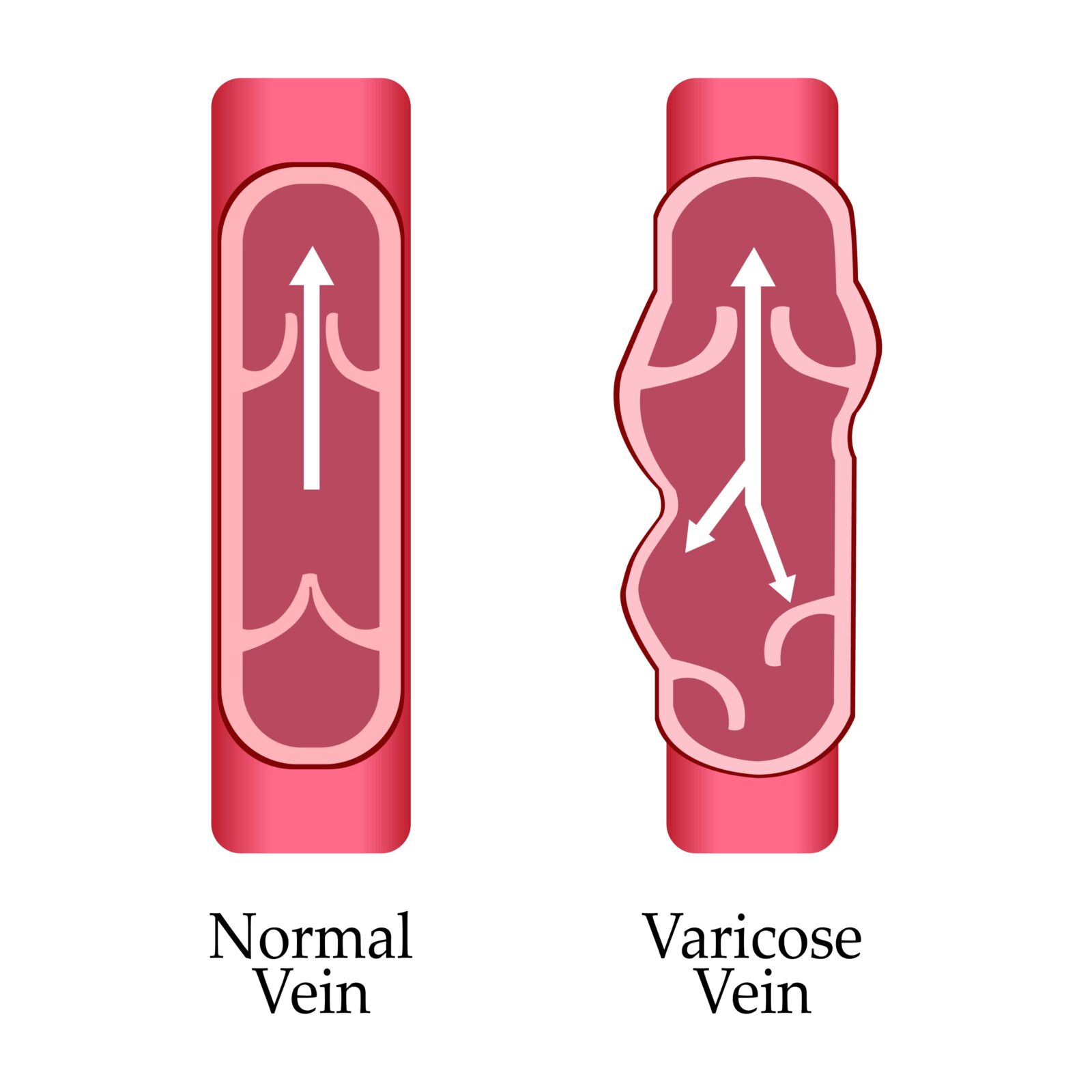 normal vein vs. varicose vein