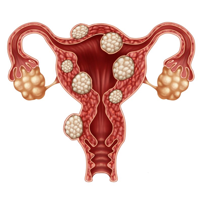 Fibroids vs. Cysts: What's the Difference? | New York City | 1 Fibroid ...