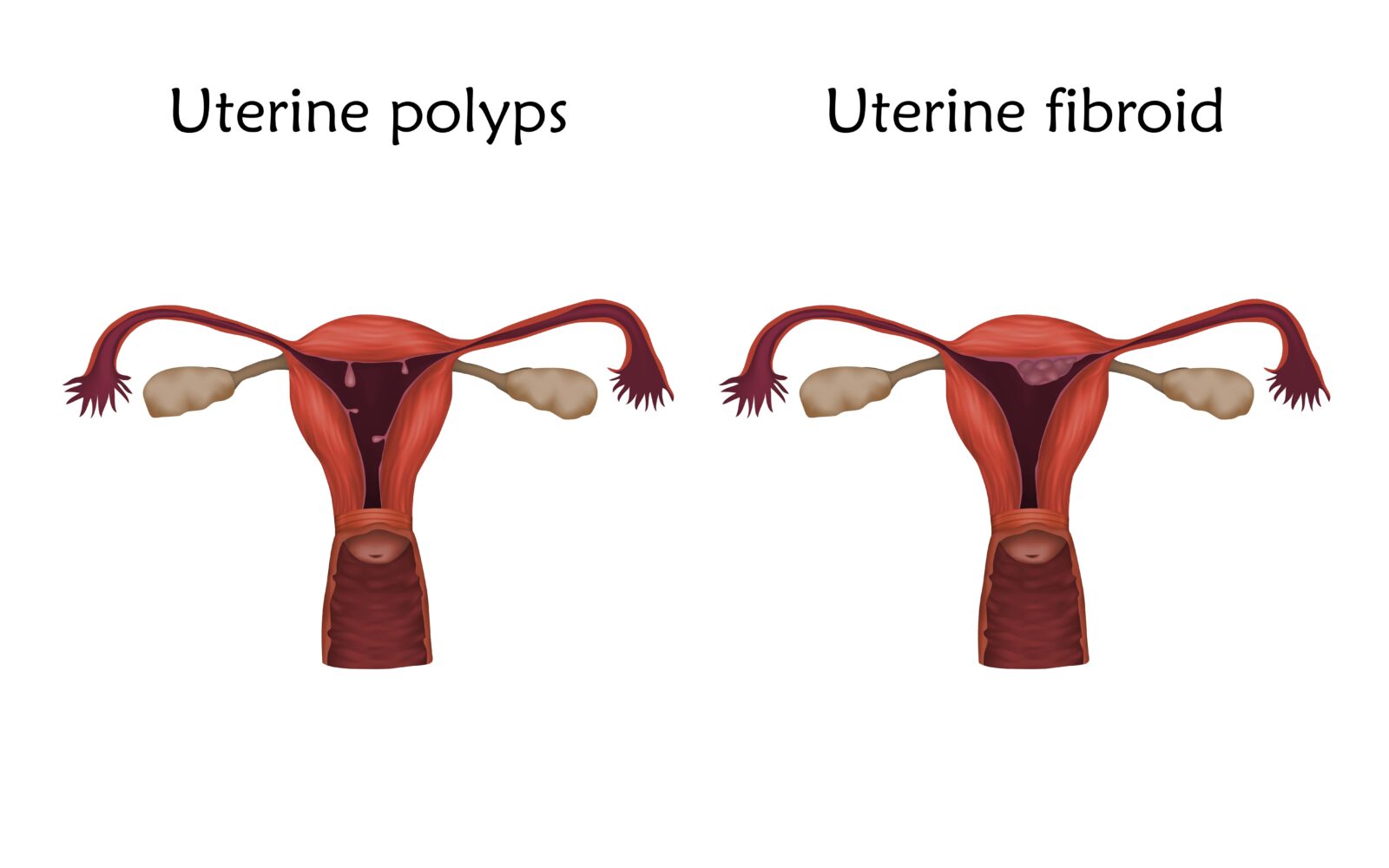 uterine polyps shown beside uterine fibroids