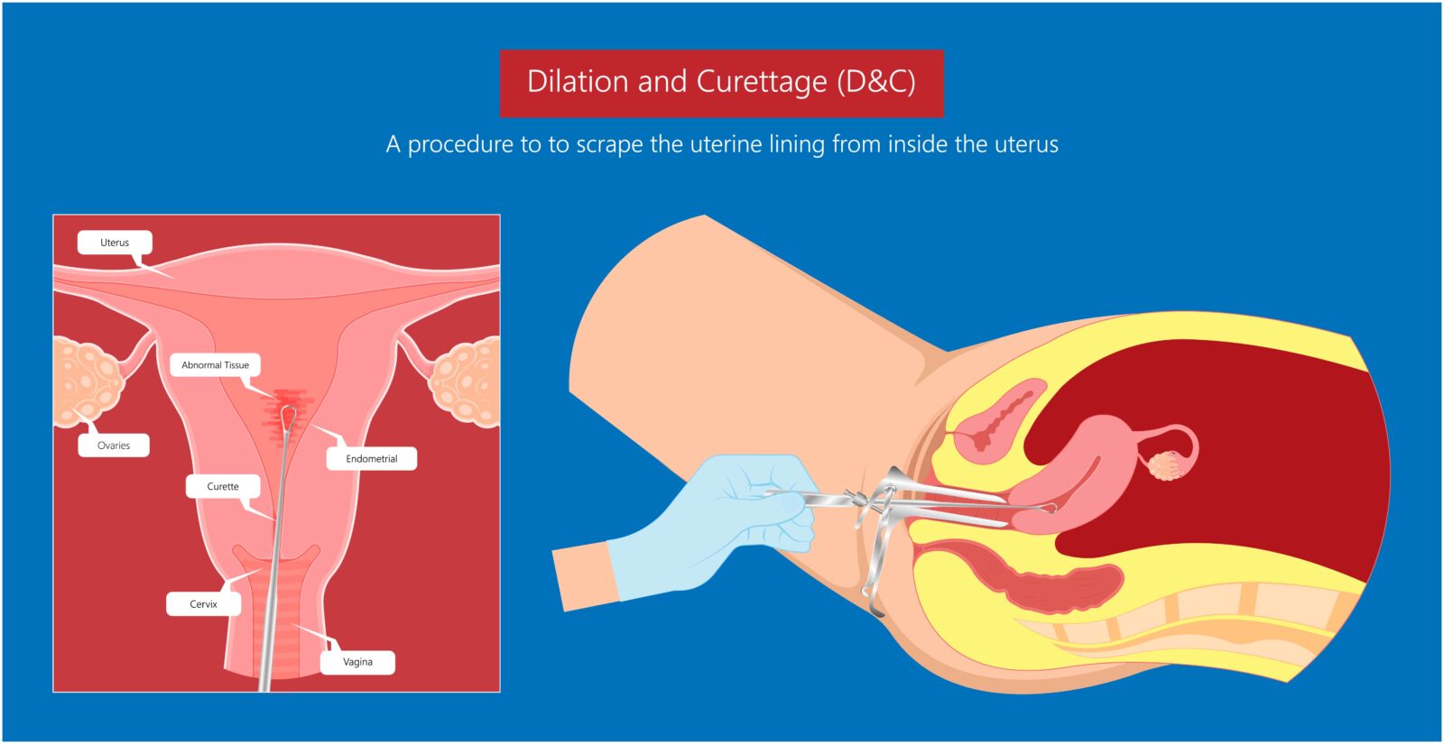 dilation & curettage (D & C)