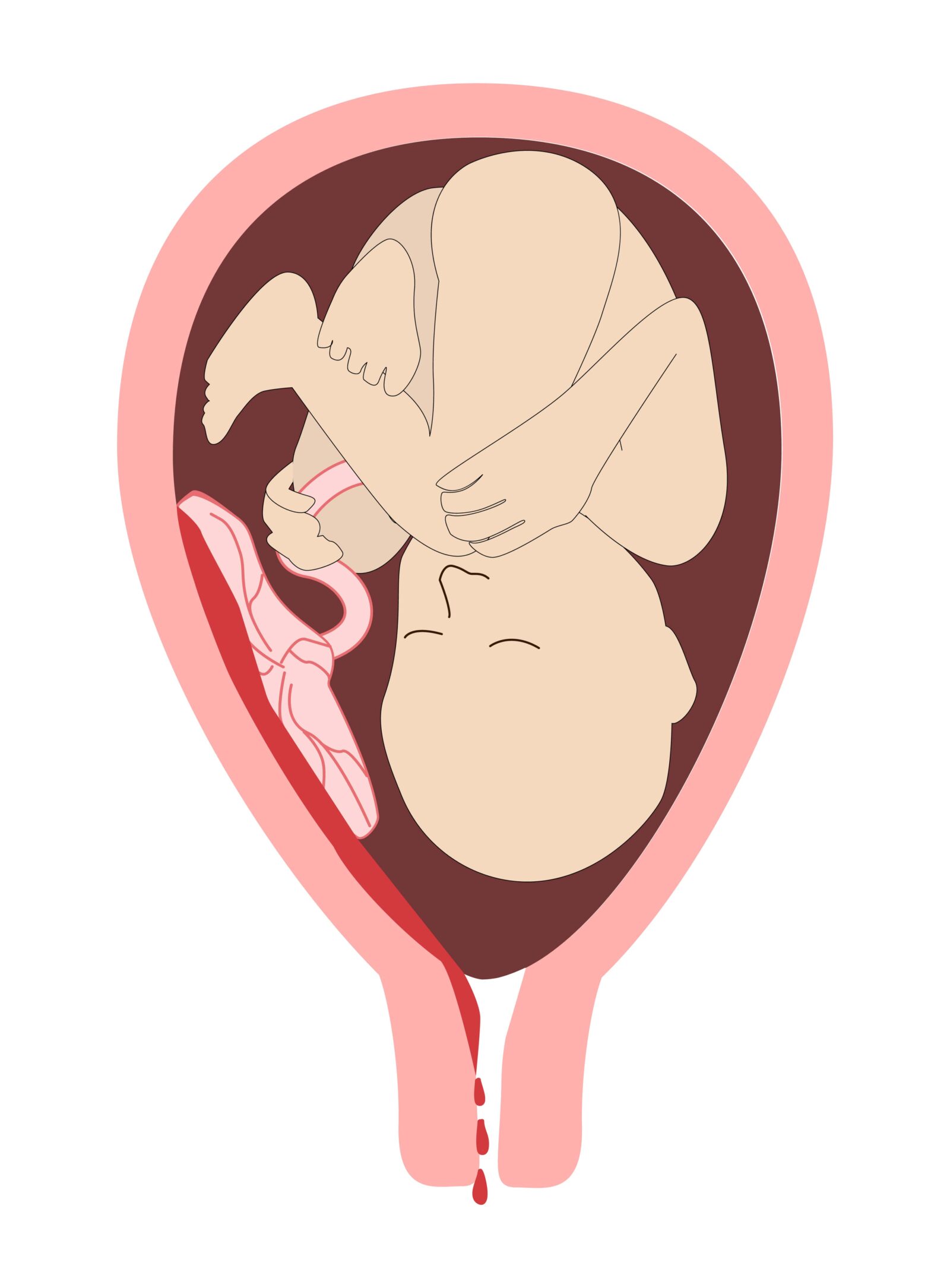 Placental Abruption