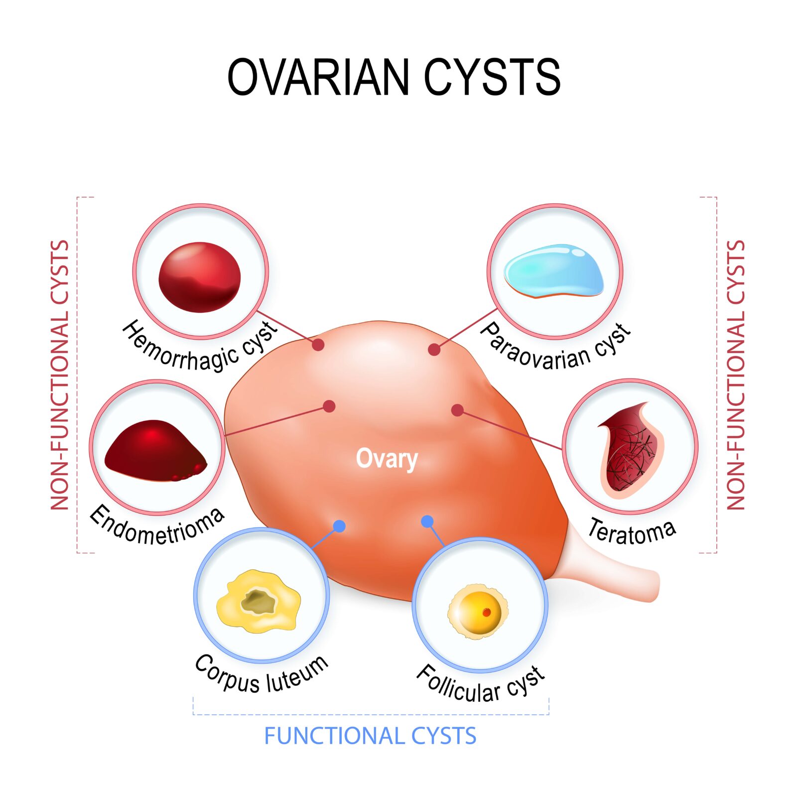 ovarian cysts and their types
