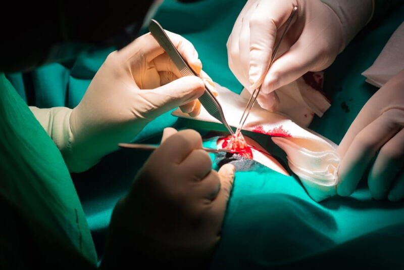 Close-up of the hands of a surgeon operating on a dermatological lesion, a fibroid