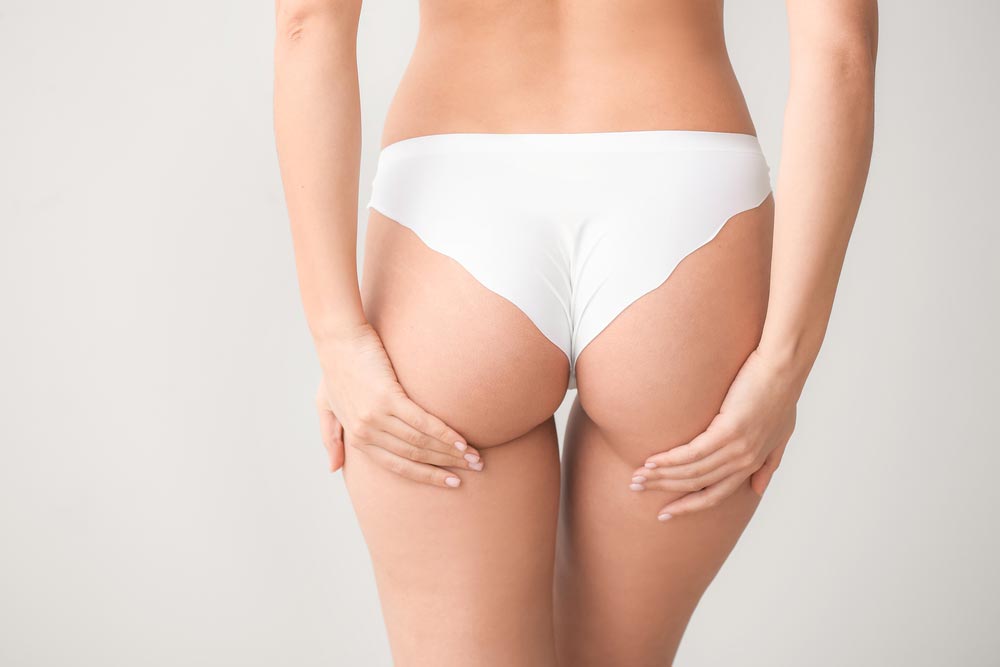 after QWO (Cellulite Injections) treatment