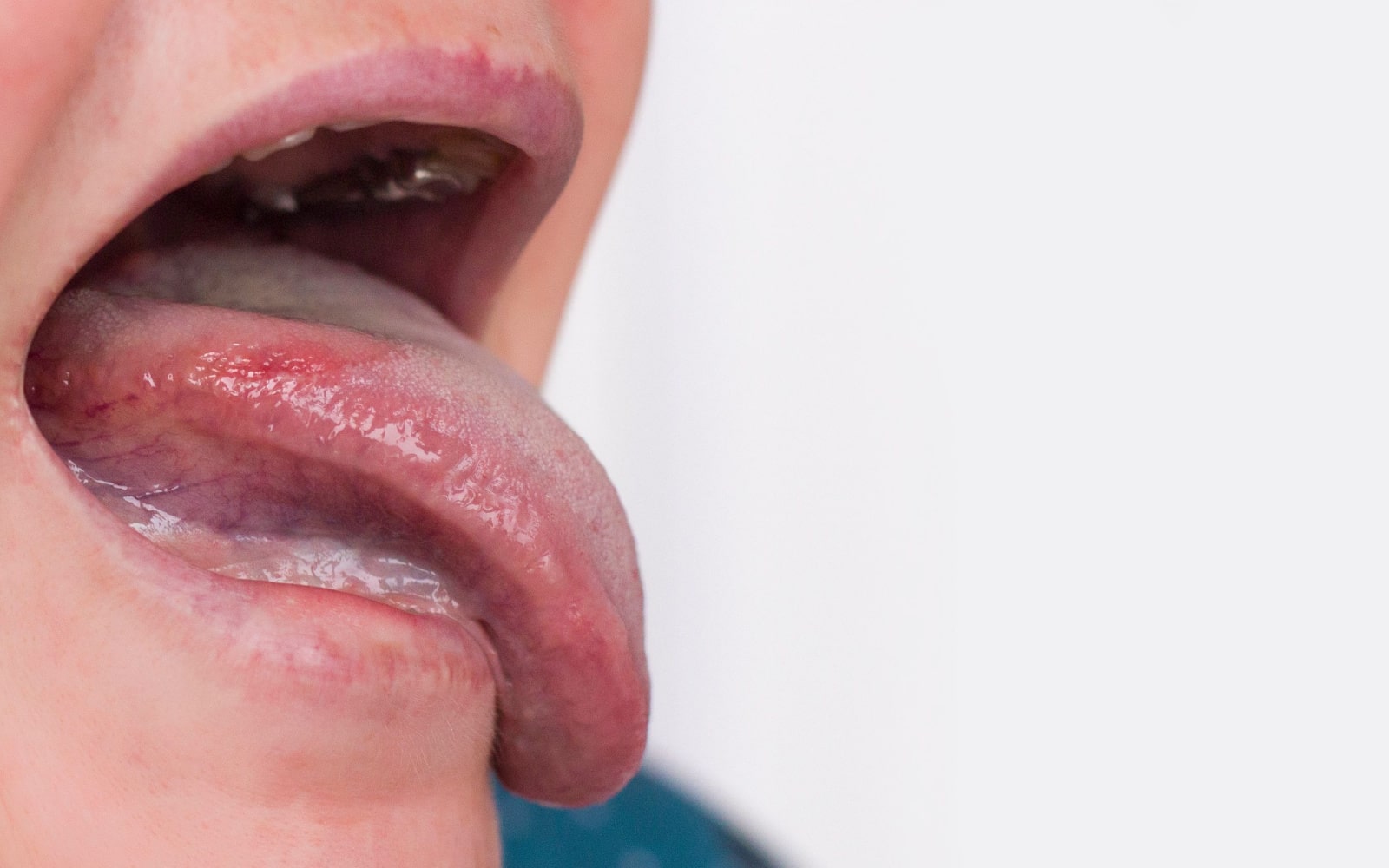 Person with oral lichen planus on their tongue and mouth