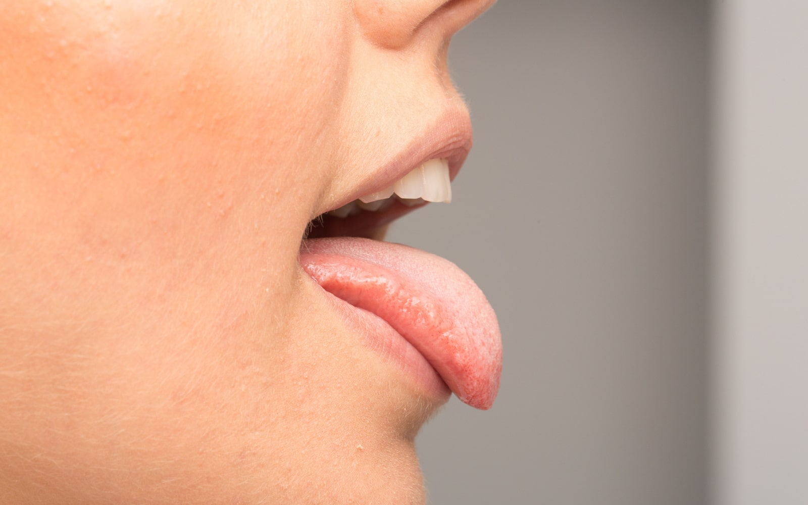 Person with tongue out side profile experiencing salivary gland disorders