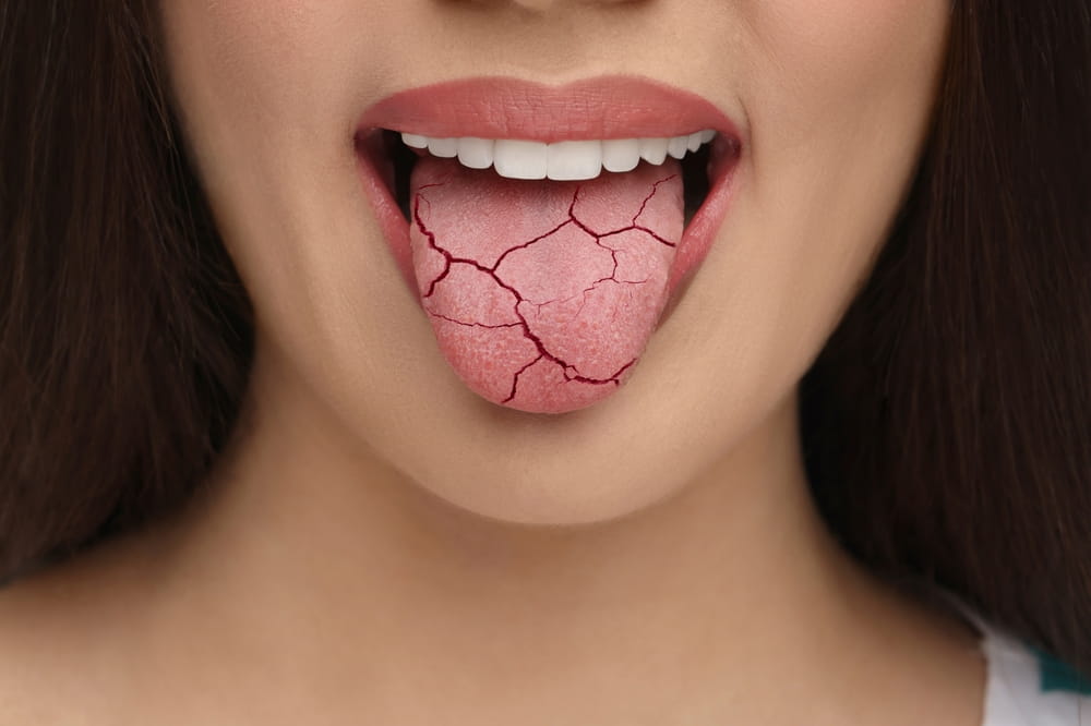 Dry mouth symptom. Woman showing dehydrated tongue, closeup