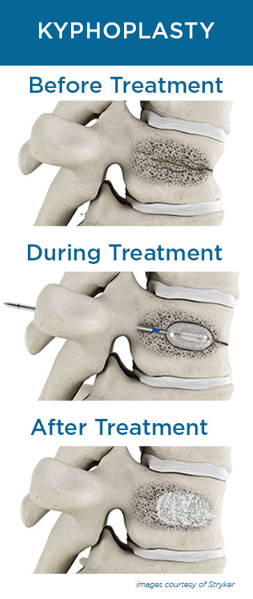 Kyphoplasty education steps