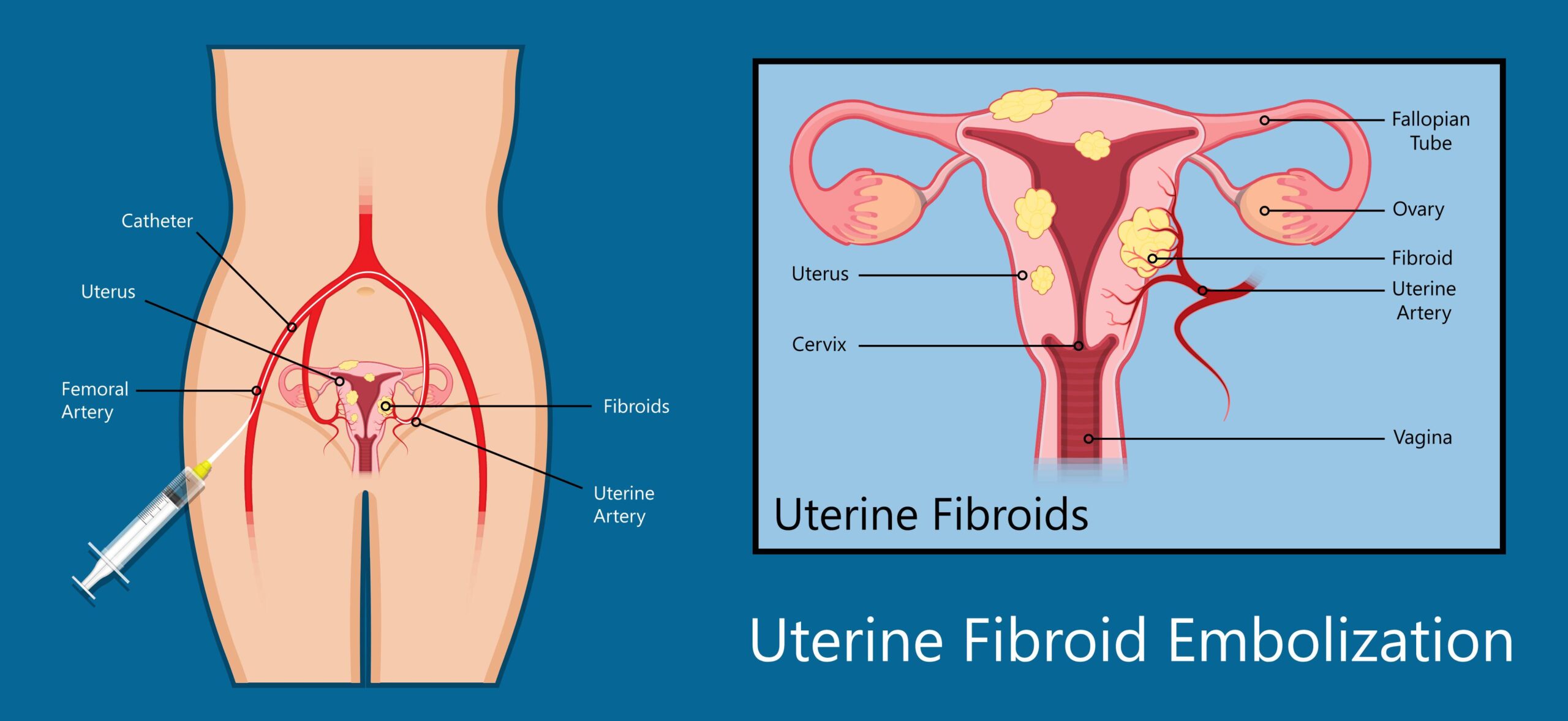 Uterine Fibroid Embolization