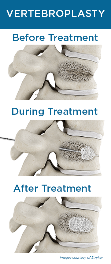 Vertebroplasty steps for education