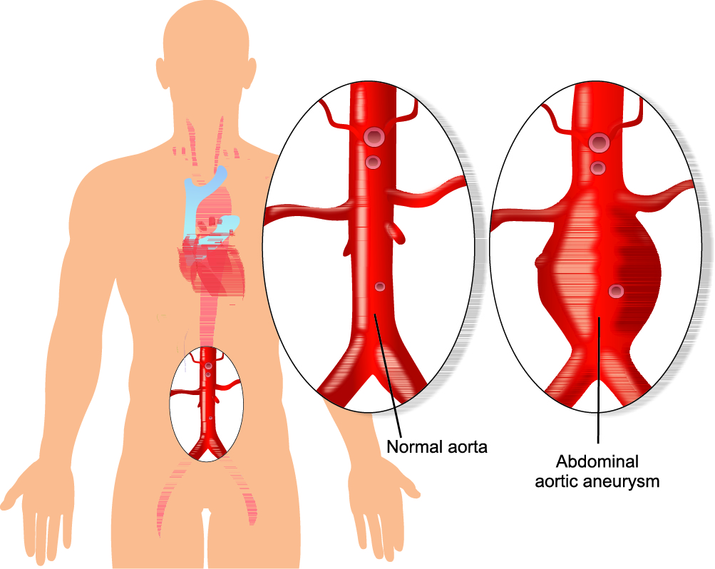 Abdominal Aortic Aneurysm