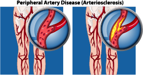 Peripheral Arterial Disease