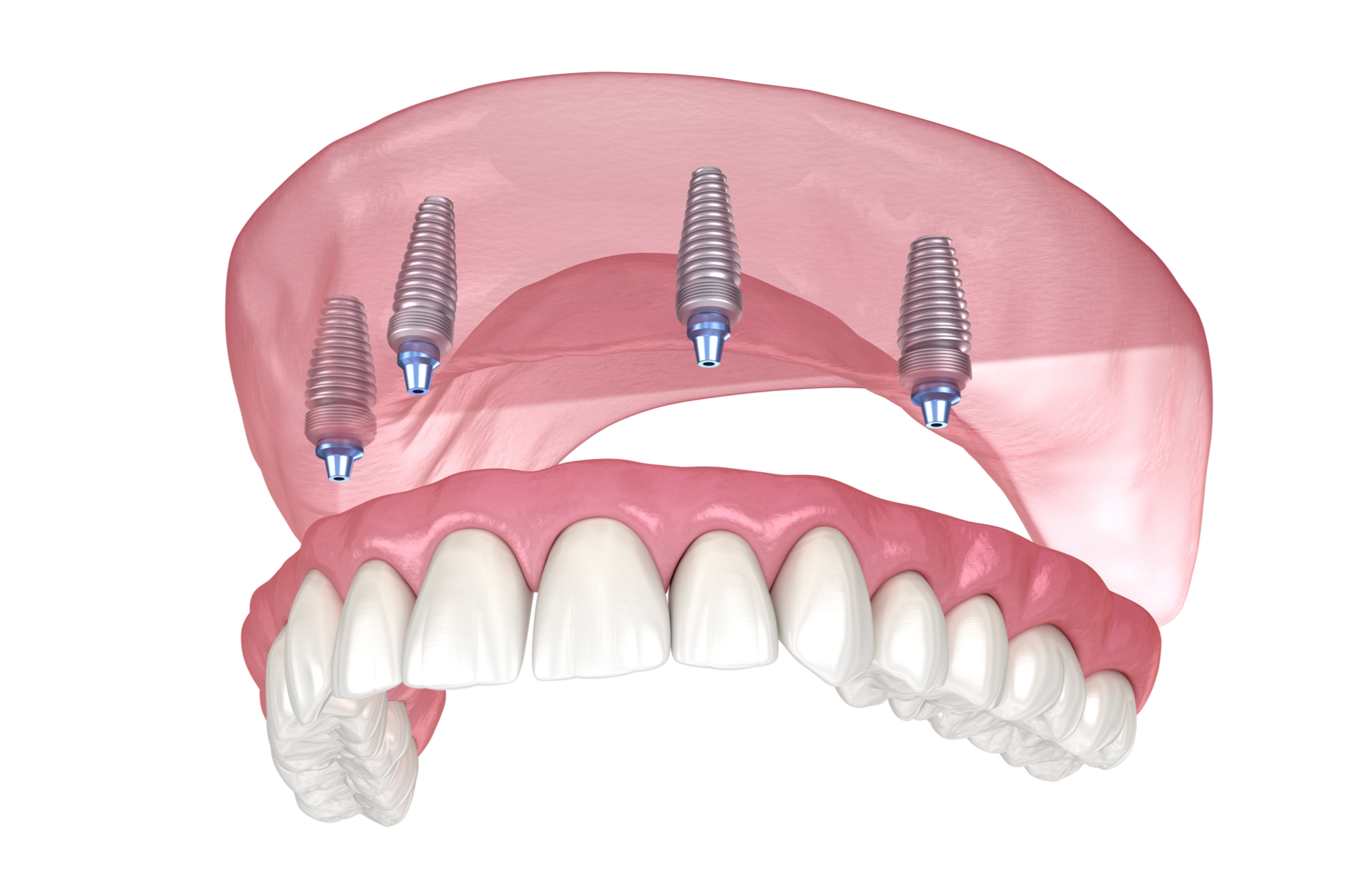 Maxillary prosthesis with gum All on 4 system supported by implants