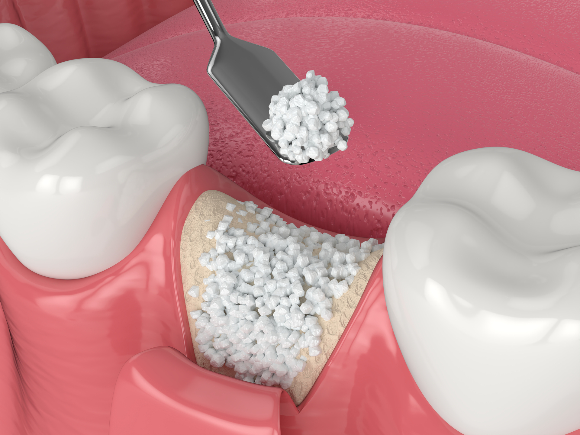 dental bone grafting with bone