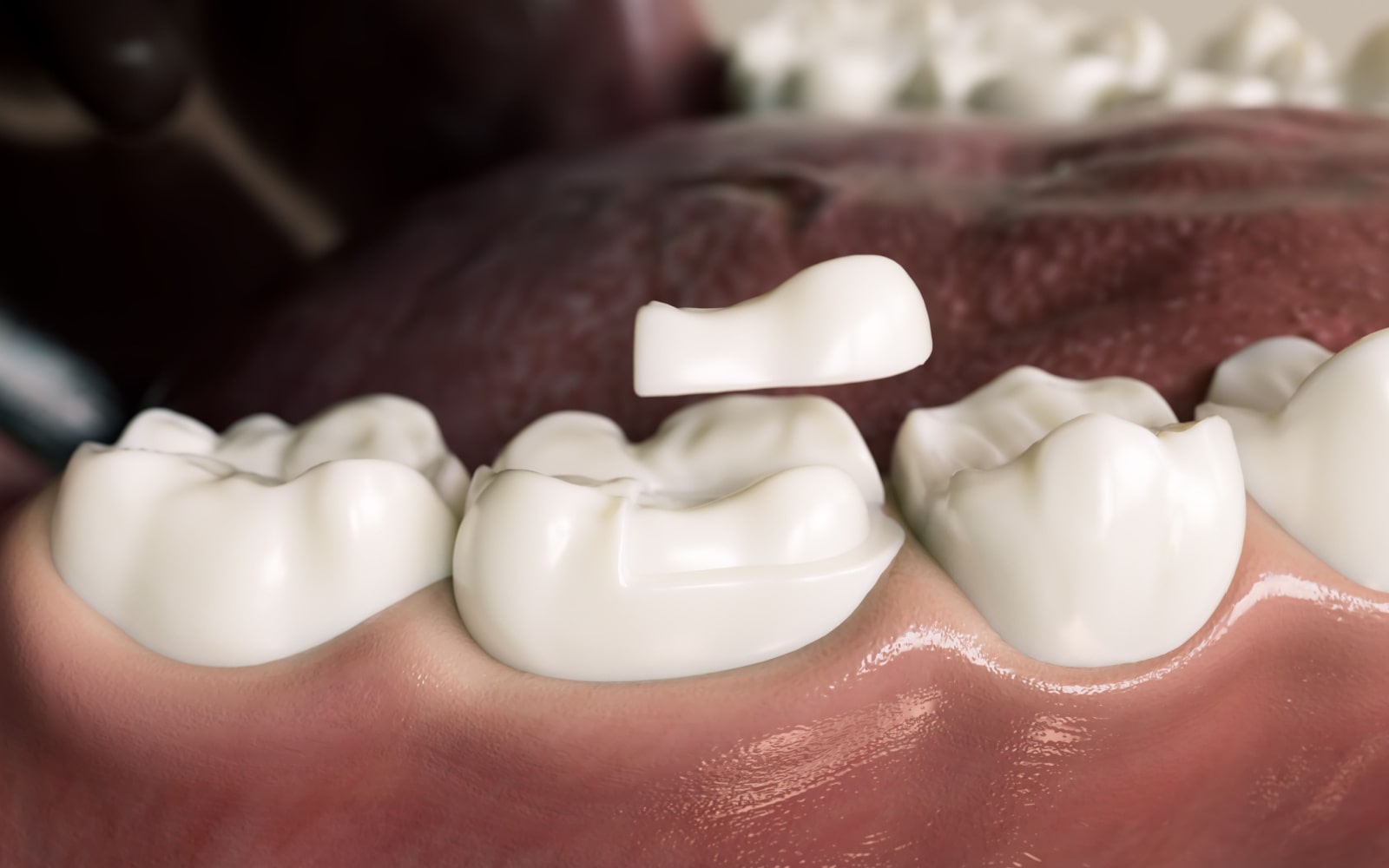 Close Up of Artificial Teeth and Dental Onlay