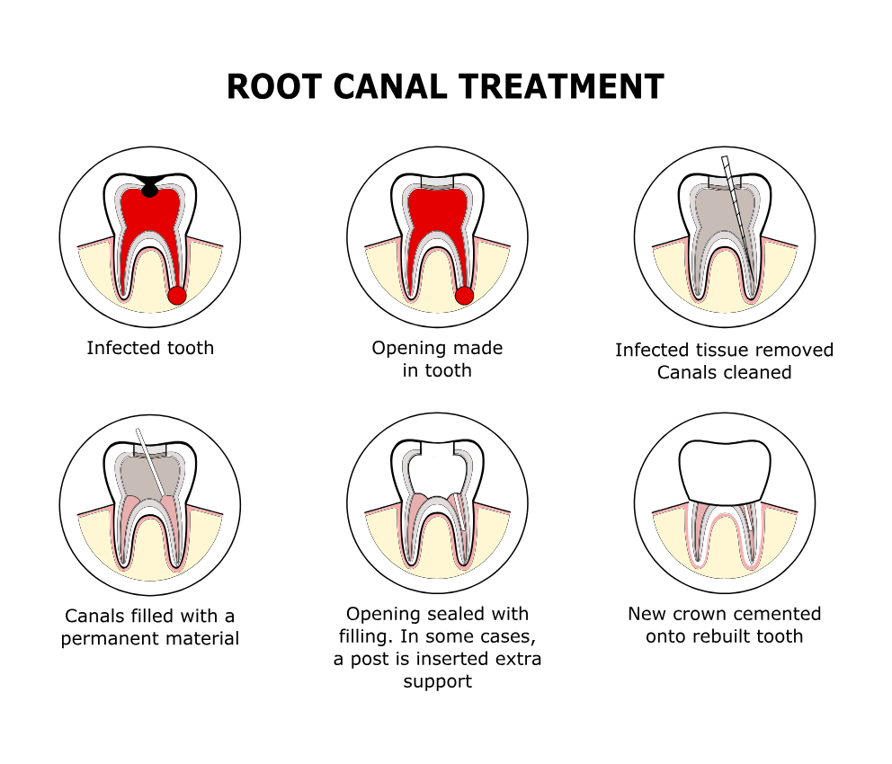An illustration of Root Canal treatment