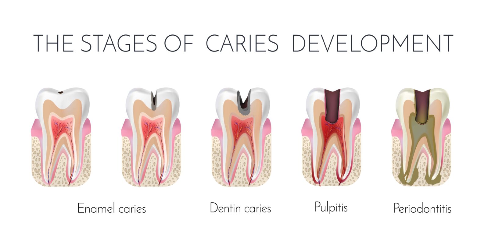 the stages of tooth decay