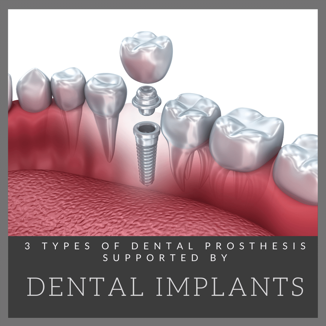 3 Types of Dental Prosthesis Supported by Dental Implants