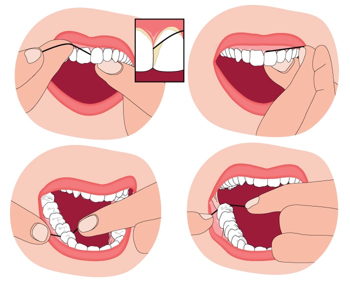 flossing technique