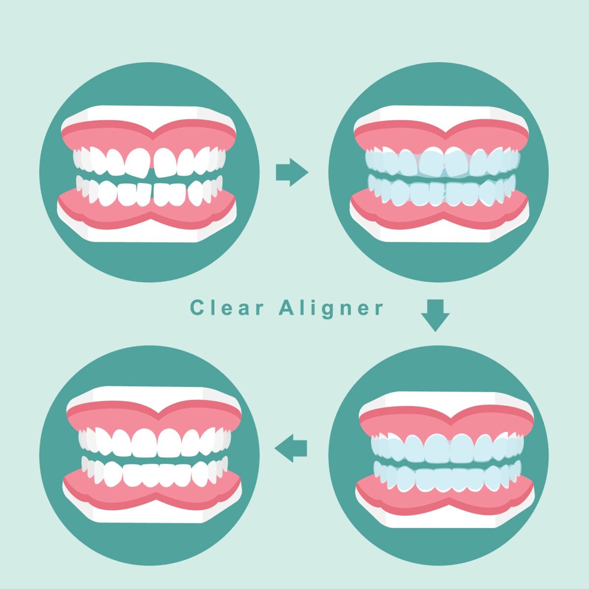 7 Reasons to Try Invisalign Treatment | Altoona, IA | Altoona Smiles