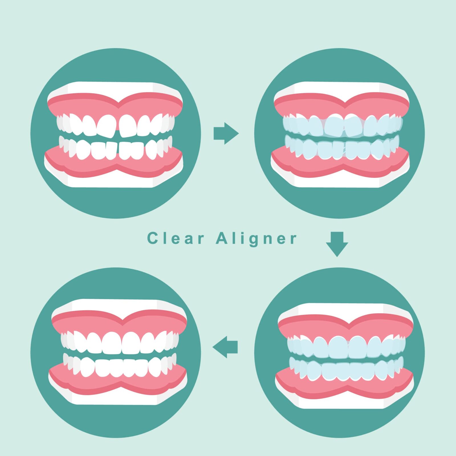 How Do Invisalign® Aligners Work ?, Invisalign Treatment Process