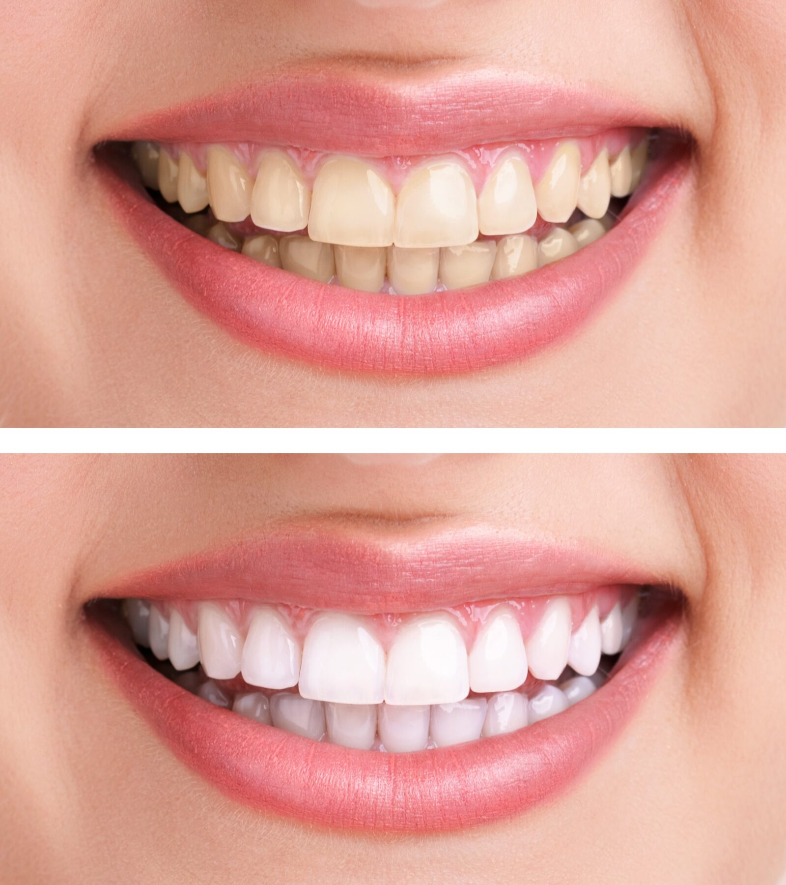 before and after teeth whitening procedure