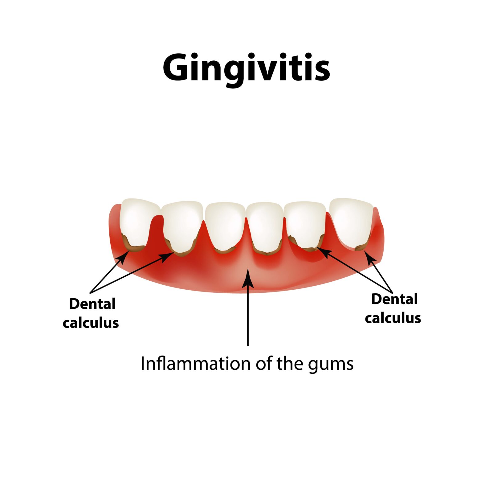 how gingivitis affects the gums