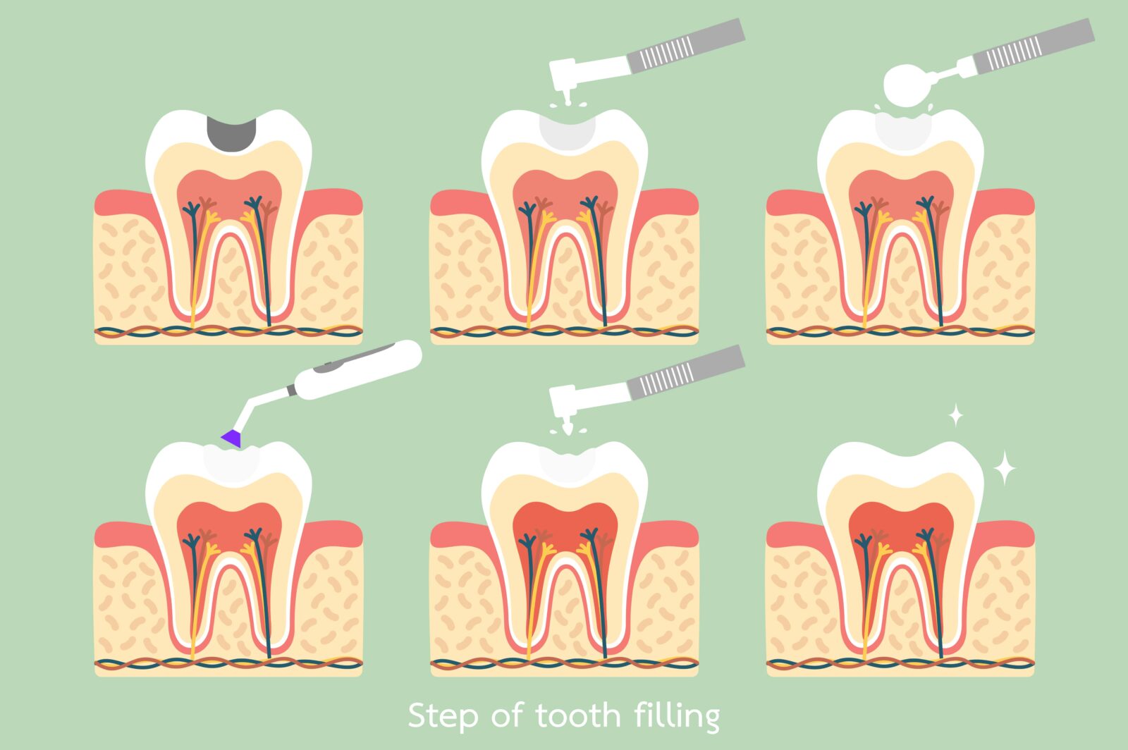 dental filling steps