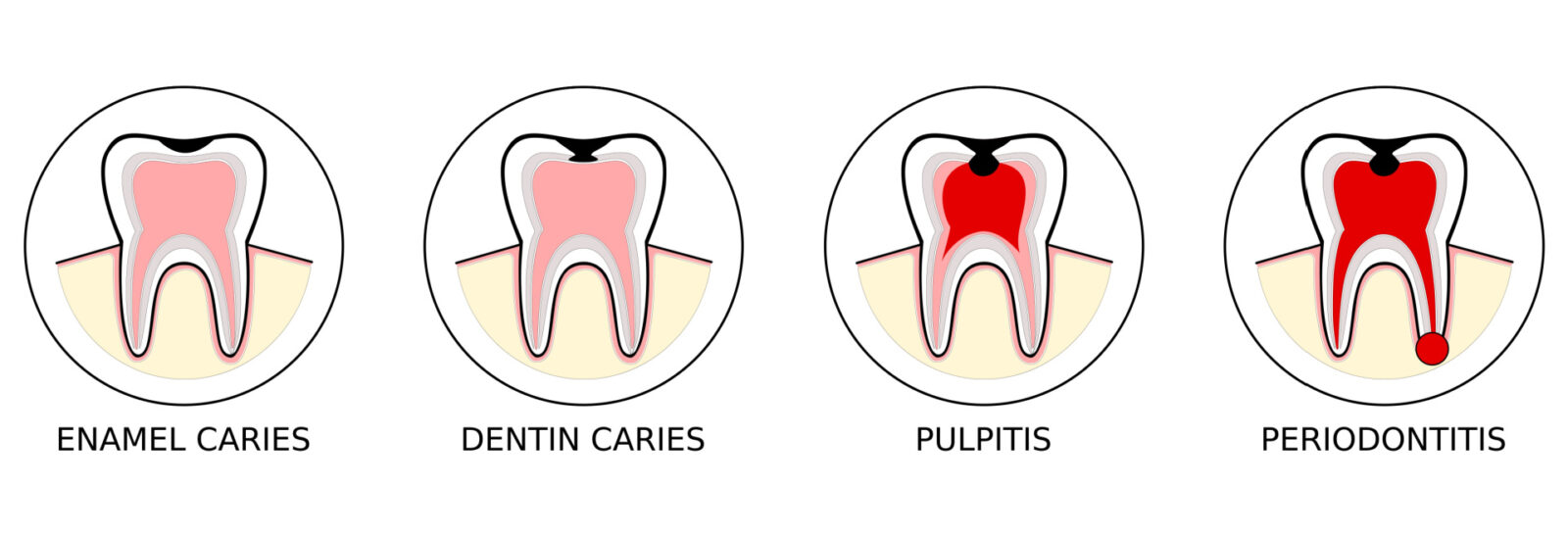 An illustration showing the stages of caries spreading to the pulp in your tooth
