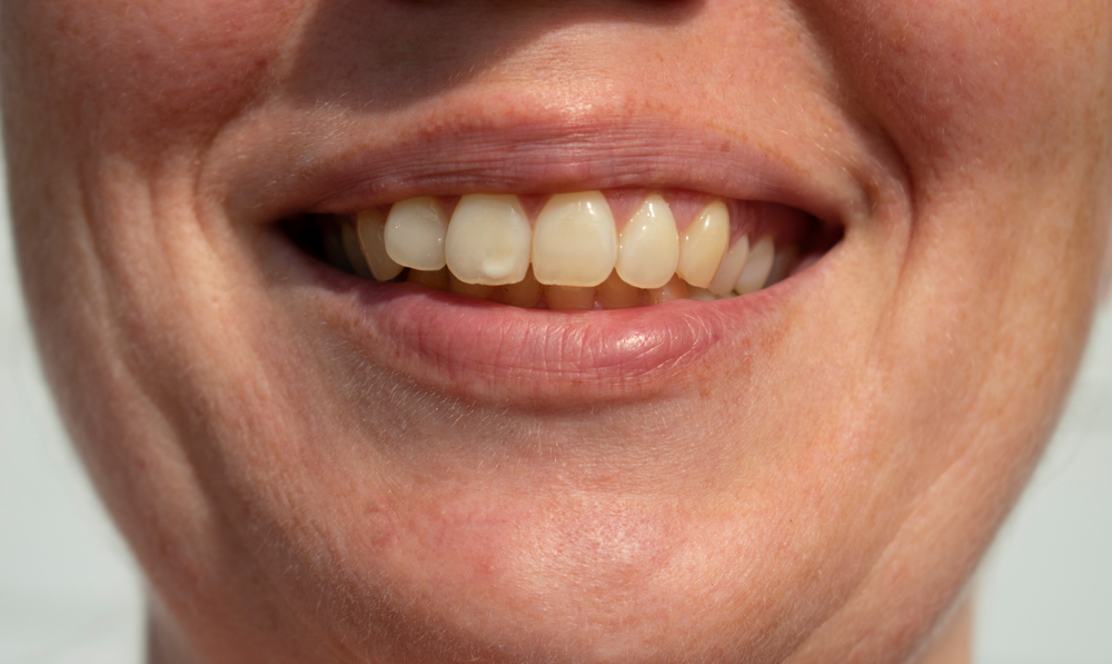 Person with stained and yellowed teeth in need of Teeth Whitening
