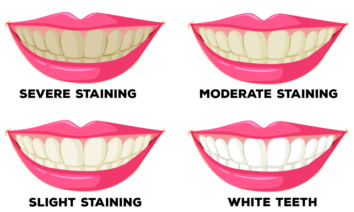 An illustration of various levels of teeth stains and how Teeth Whitening can help