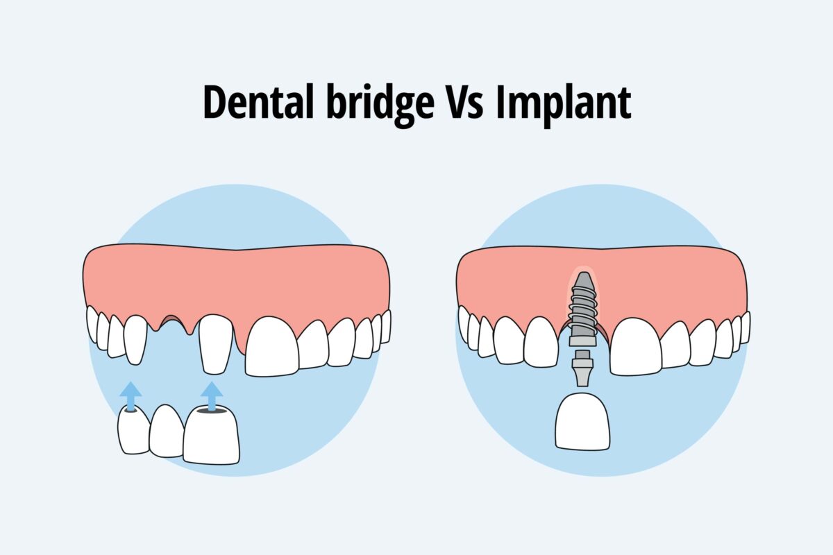dental bridge vs. implant