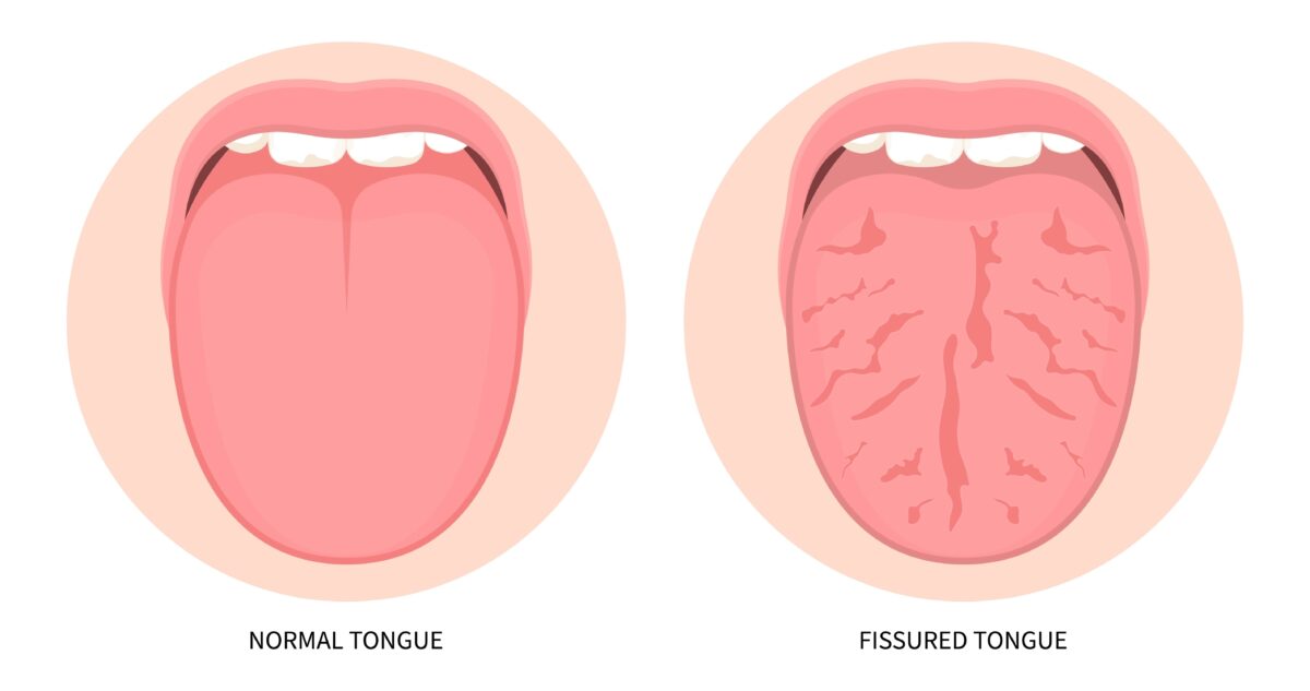 Tongue Abnormalities That Can Impact Your Oral Health | Altoona, IA ...