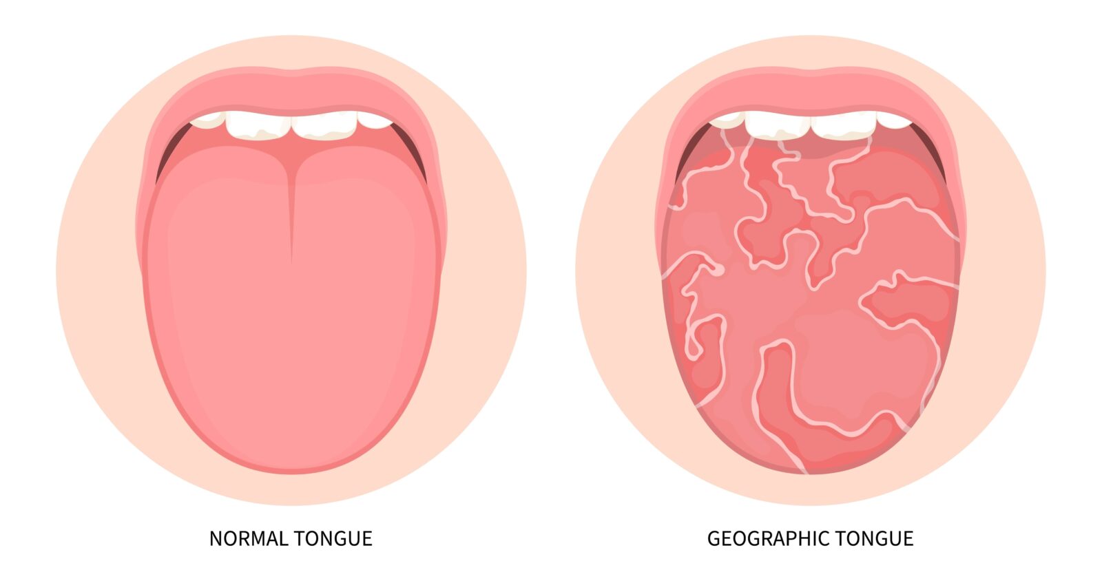 Tongue Abnormalities That Can Impact Your Oral Health | Altoona, IA ...