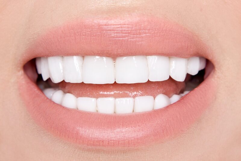 beautiful smile with veneers. closeup