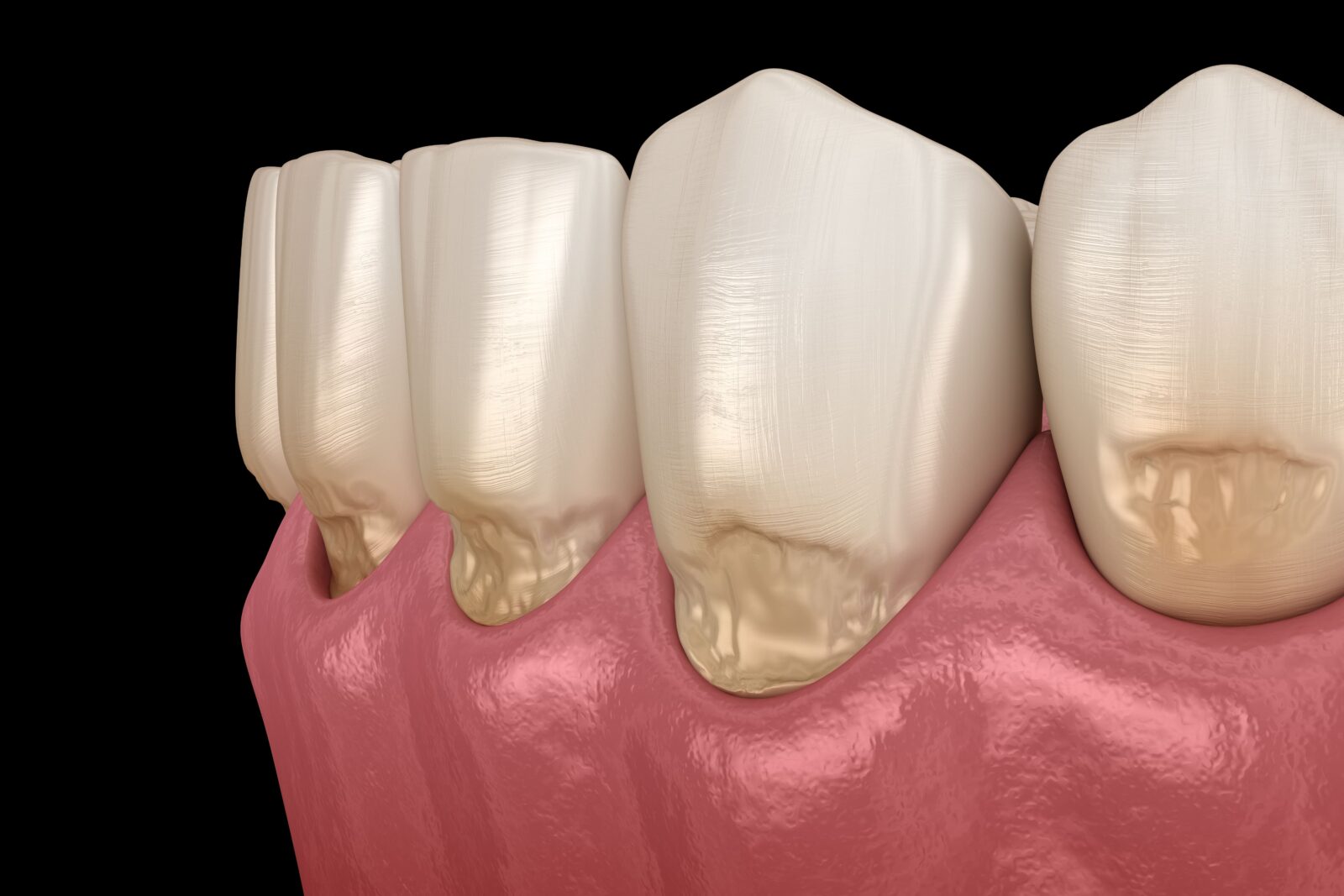 abfraction of anterior teeth