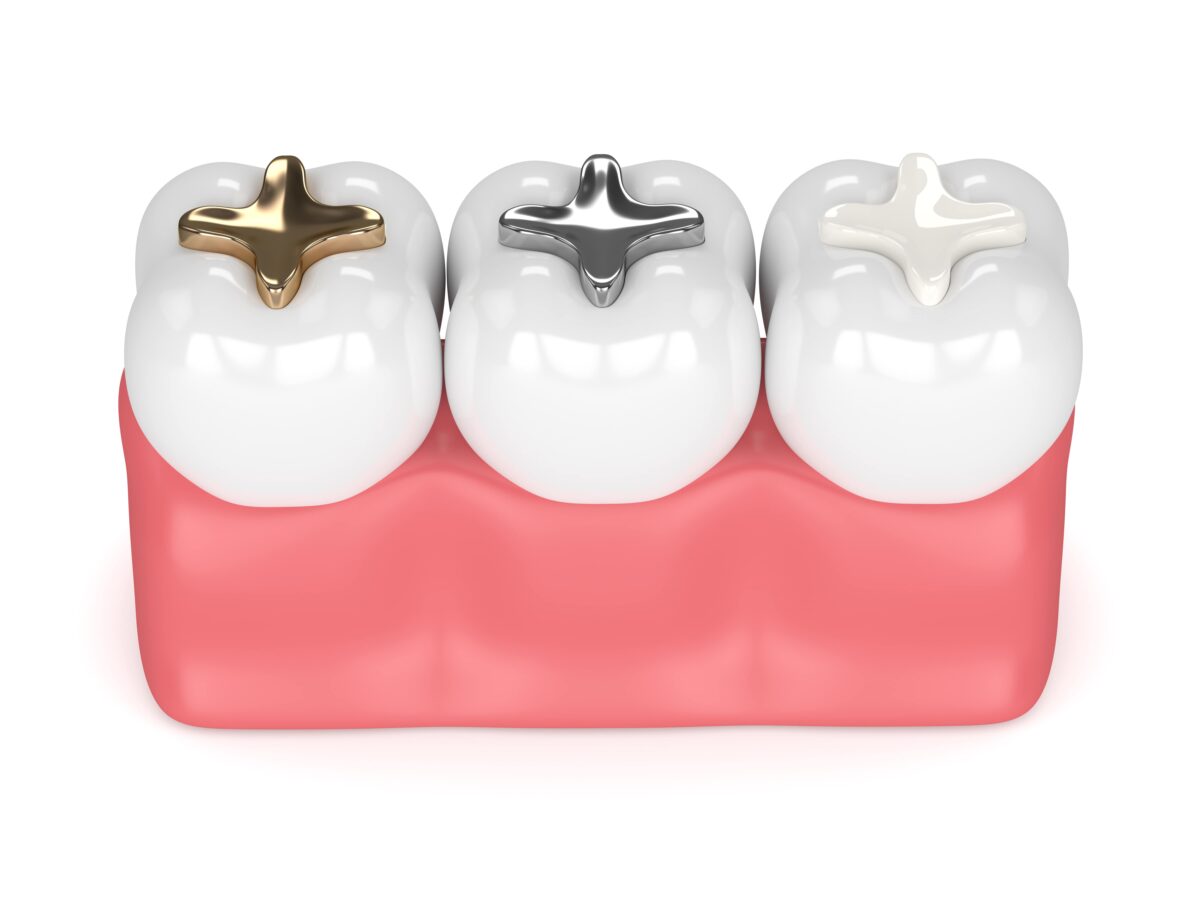 different types of dental fillings: gold, amalgam, composite resin
