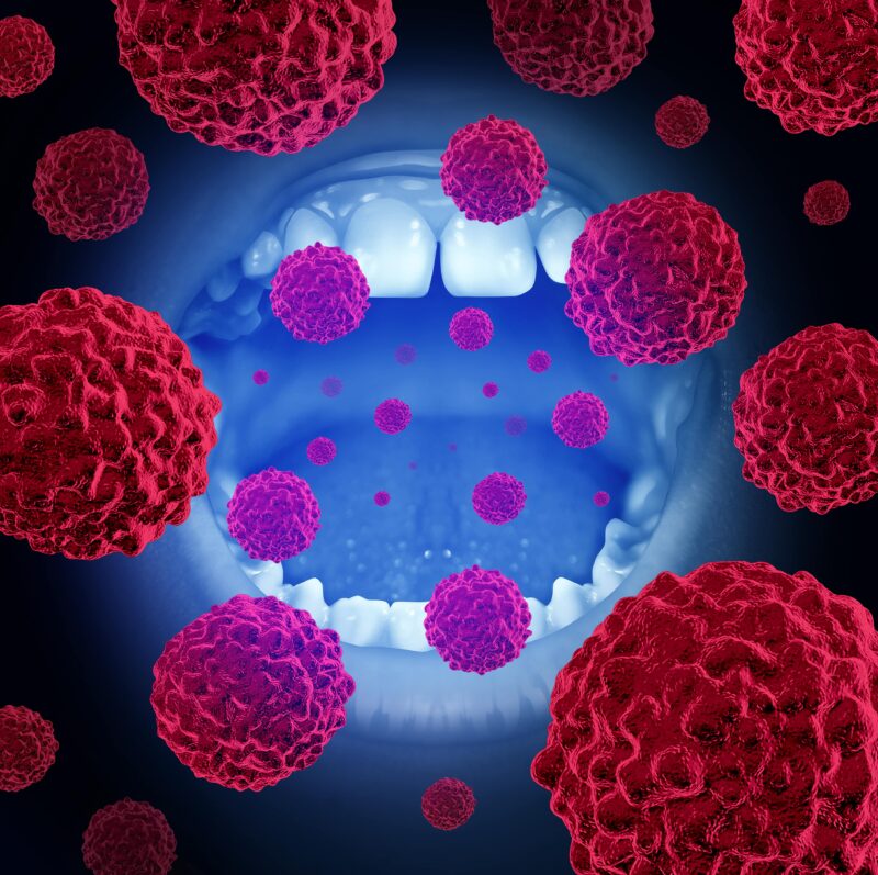 Oral cancer medical concept as a mouth with malignant disease cells with 3D illustration elements.