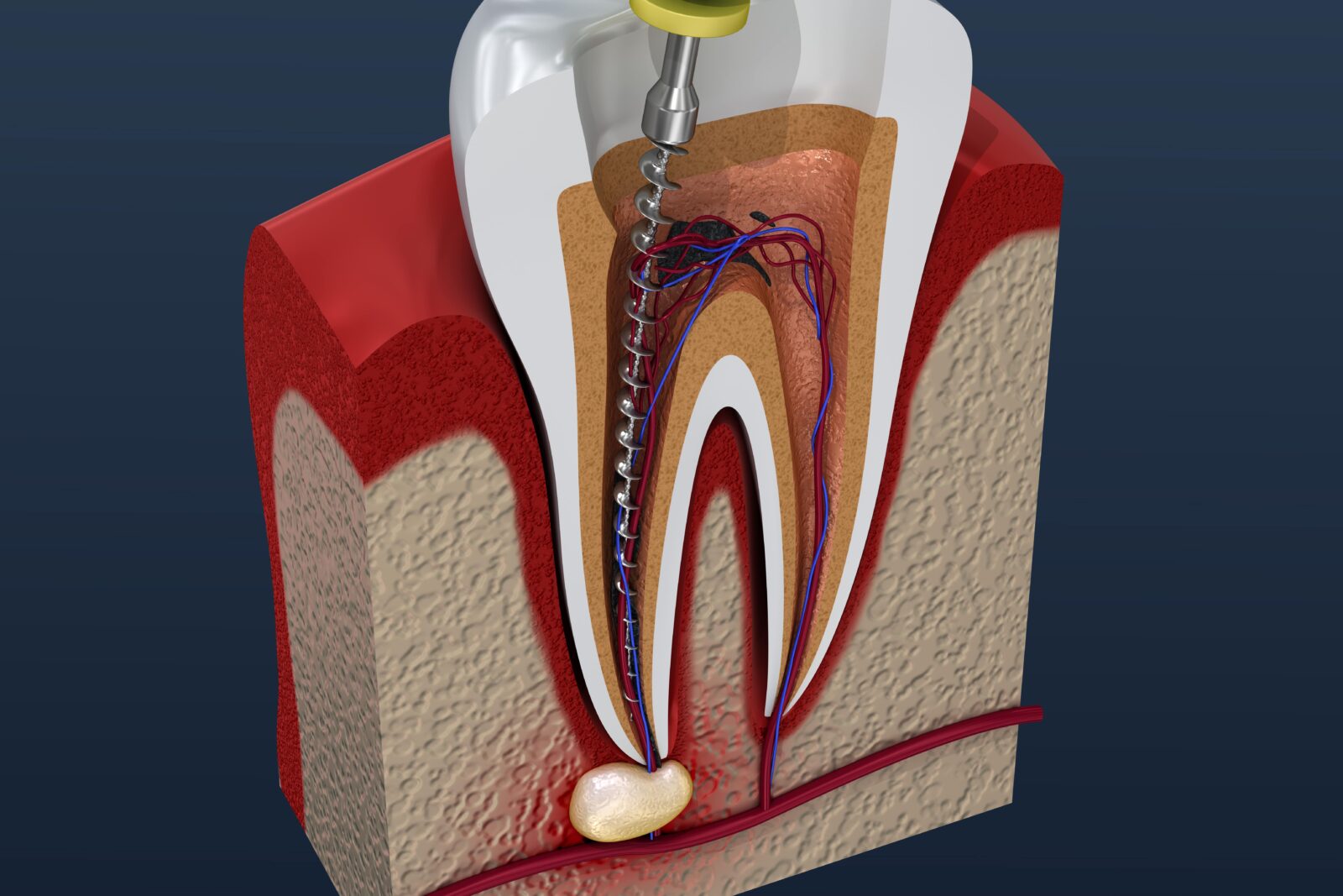 dental file being used to clean the inside of the tooth