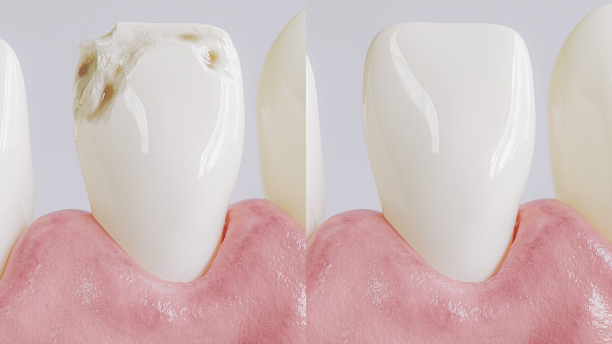 before and after dental filling