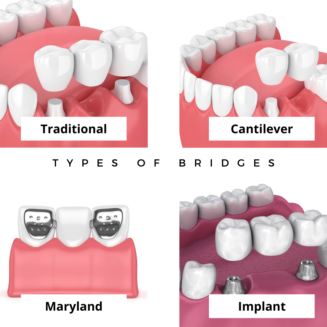 different types of dental bridges