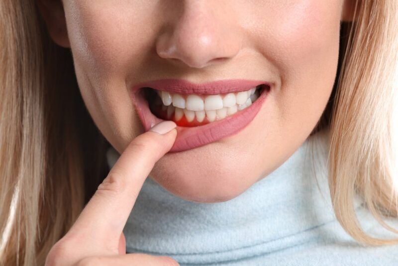 woman with gum irritation