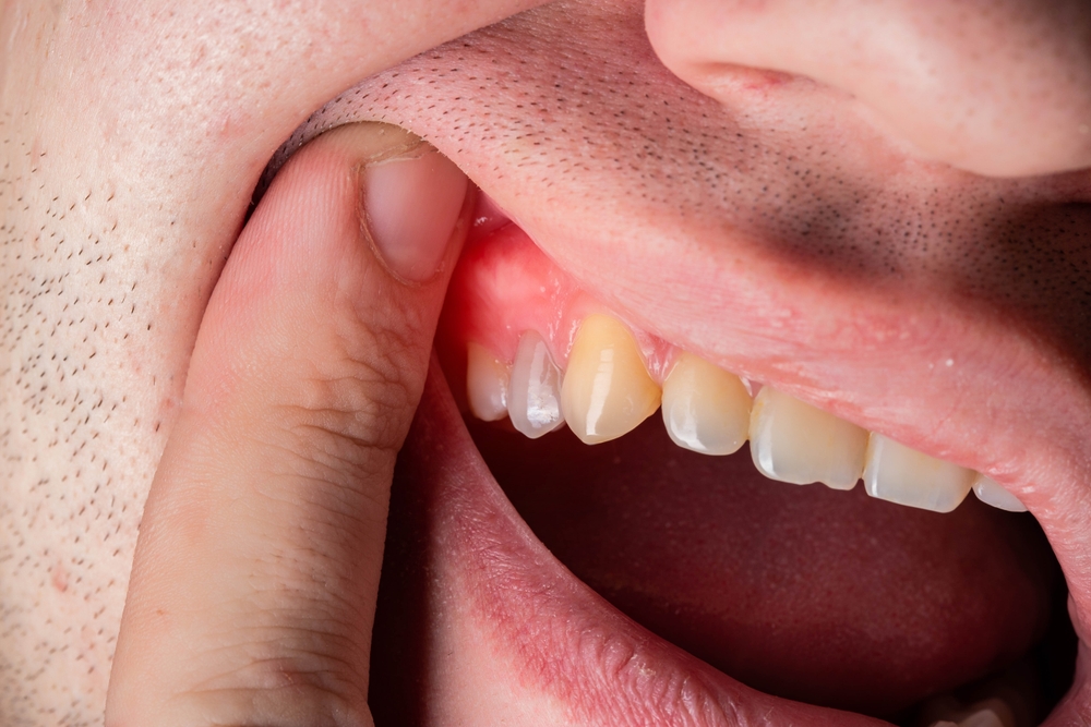 How to handle a dental abscess