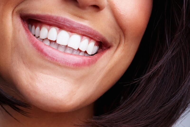 Teeth whitening: is it right for you?