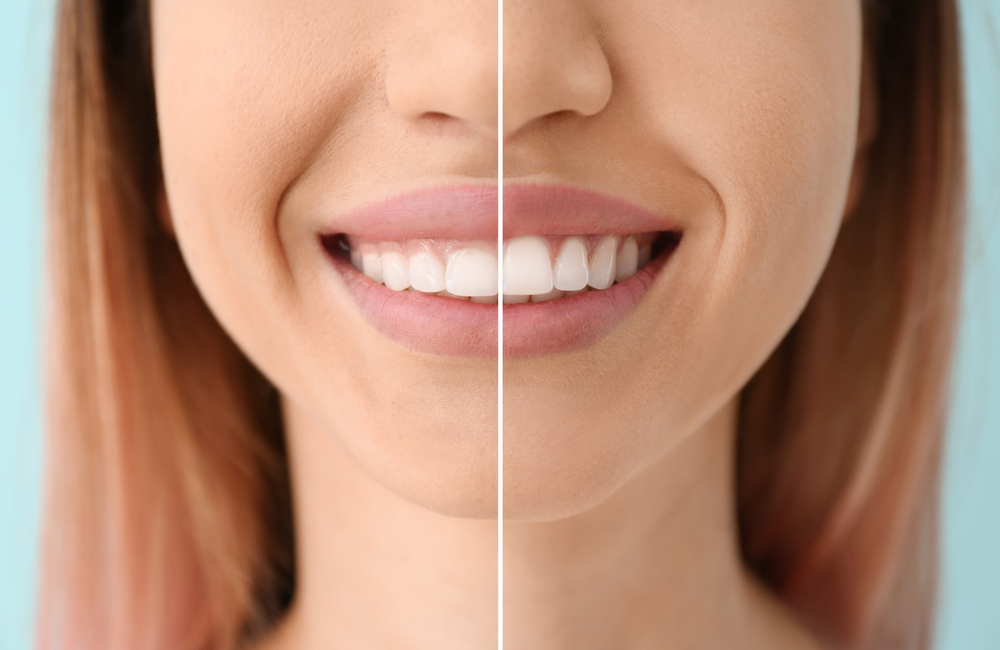 benefits of gum contouring for smile enhancement