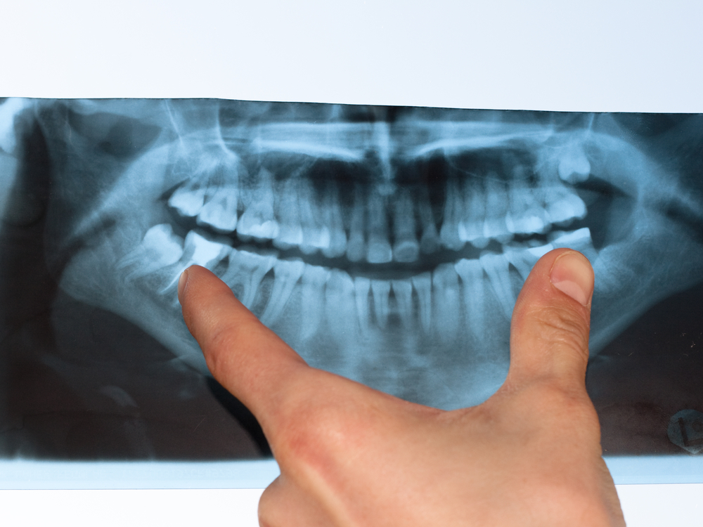 How a Dentist Can Detect Signs of Osteoporosis