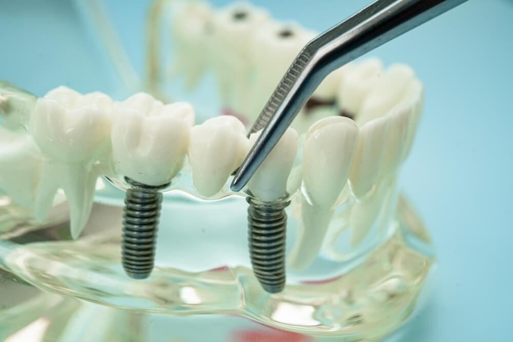 Dental Implant